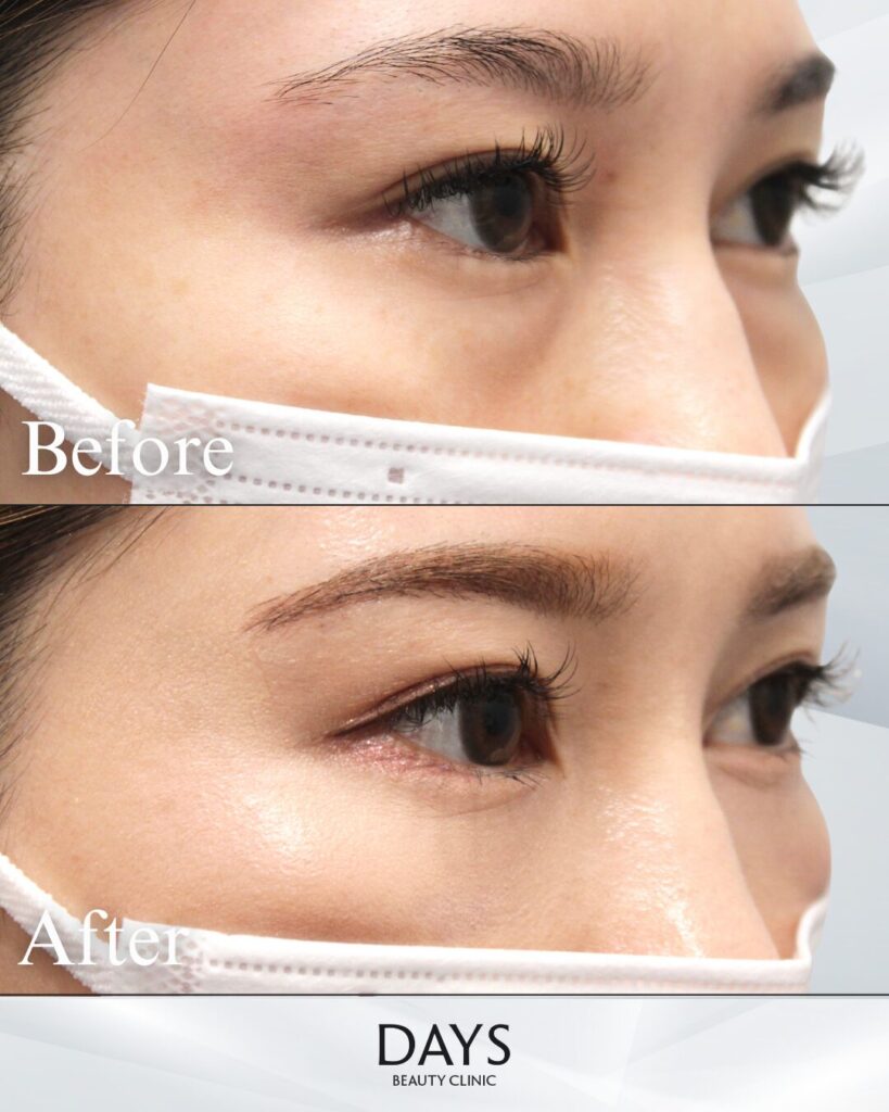 クマ取り　症例　20代女性