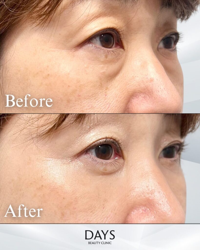 クマ取り　症例　50代女性