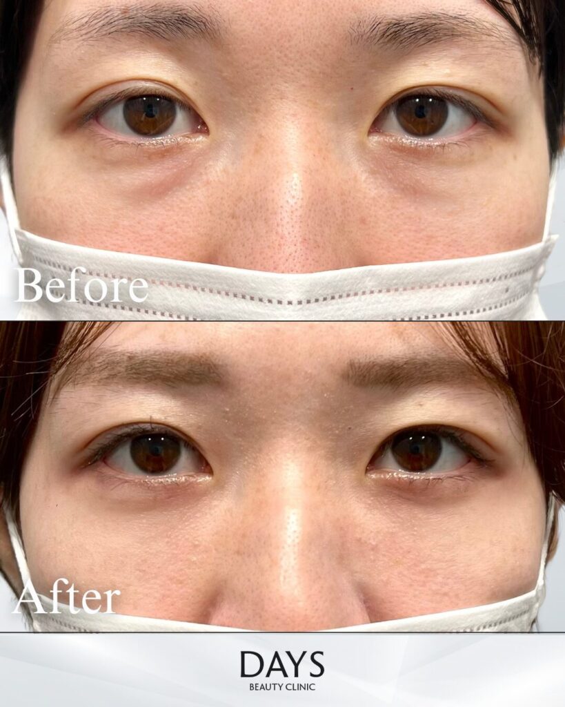 裏ハムラ　症例　30代女性