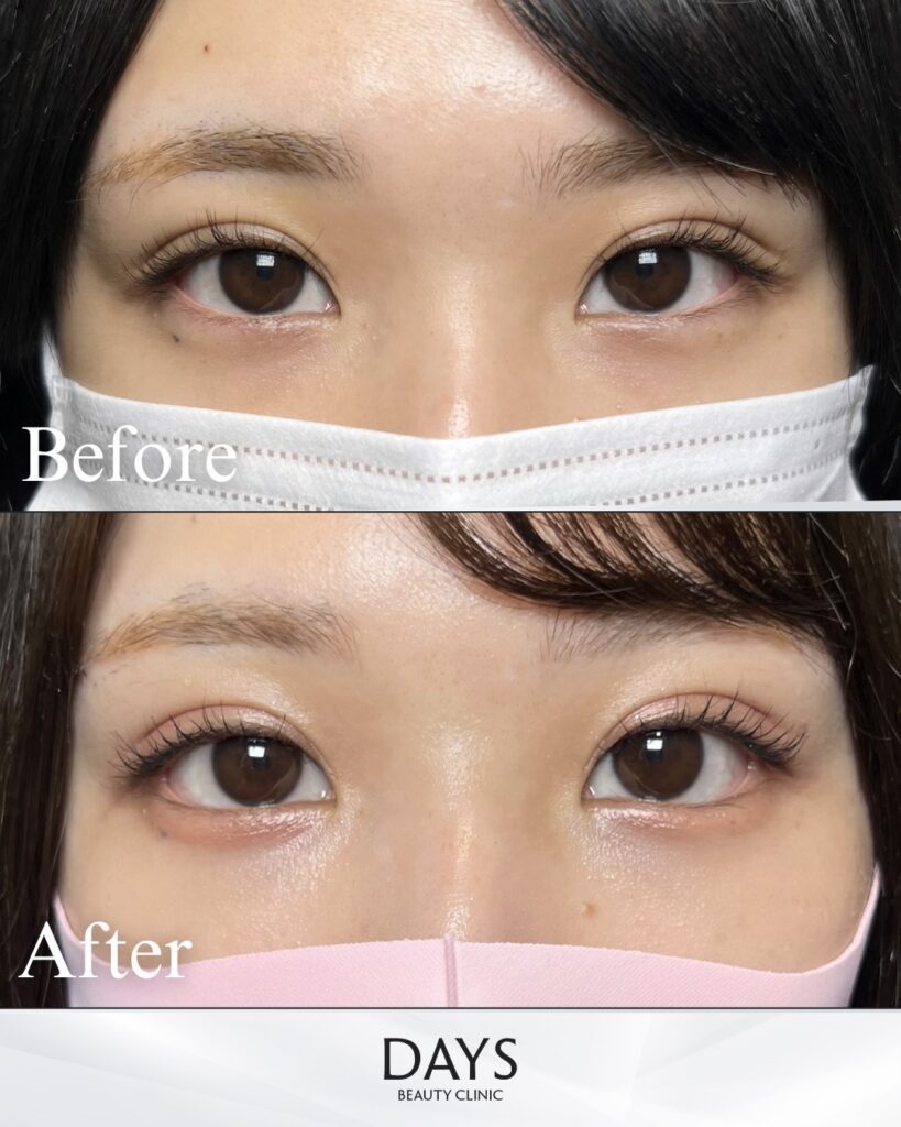 タレ目形成　症例　20代女性