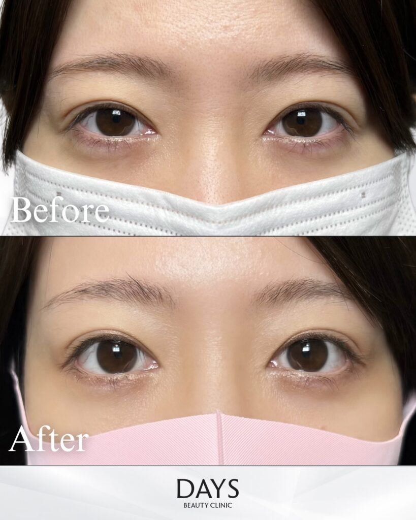 グラマラスライン形成　症例　20代女性