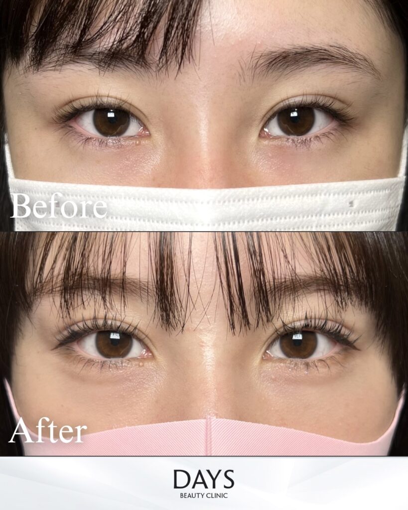 タレ目形成　症例　20代女性