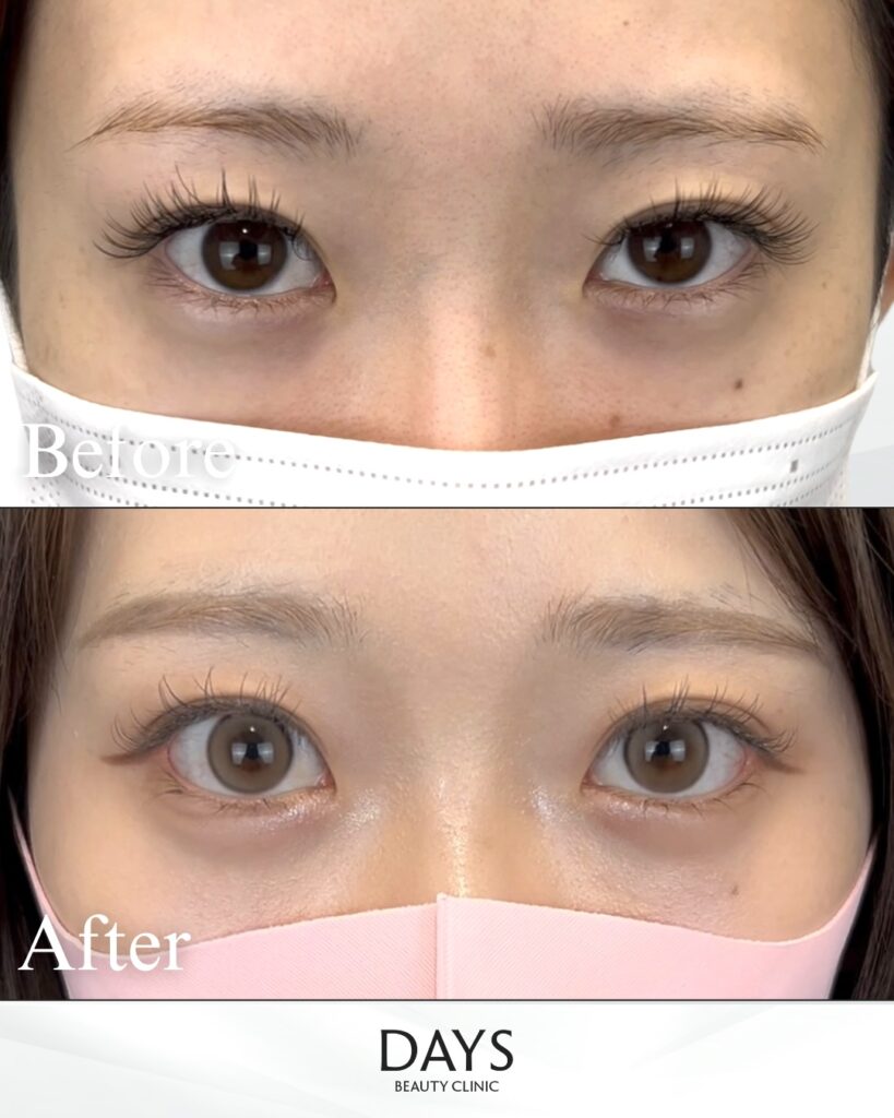 タレ目形成　症例　20代女性