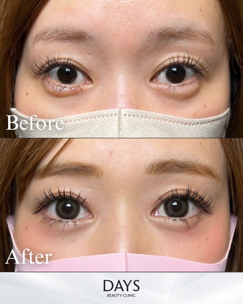 タレ目形成　症例　20代女性