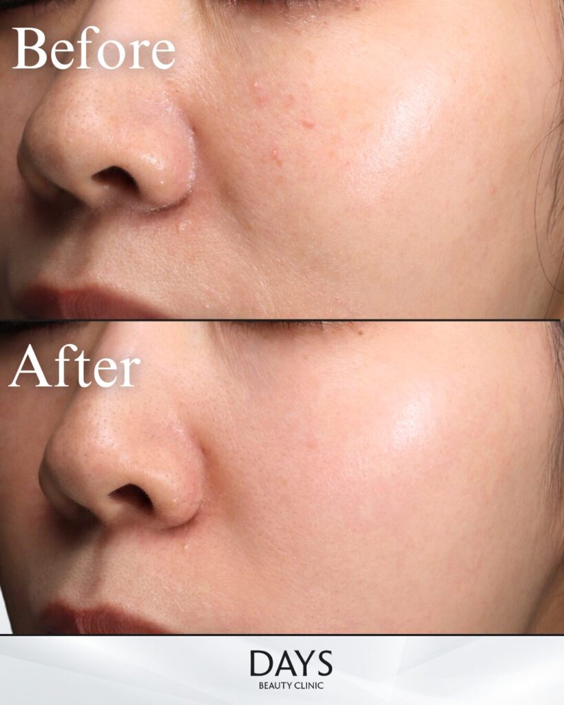 プルリアルデンシファイ-の症例　20代女性