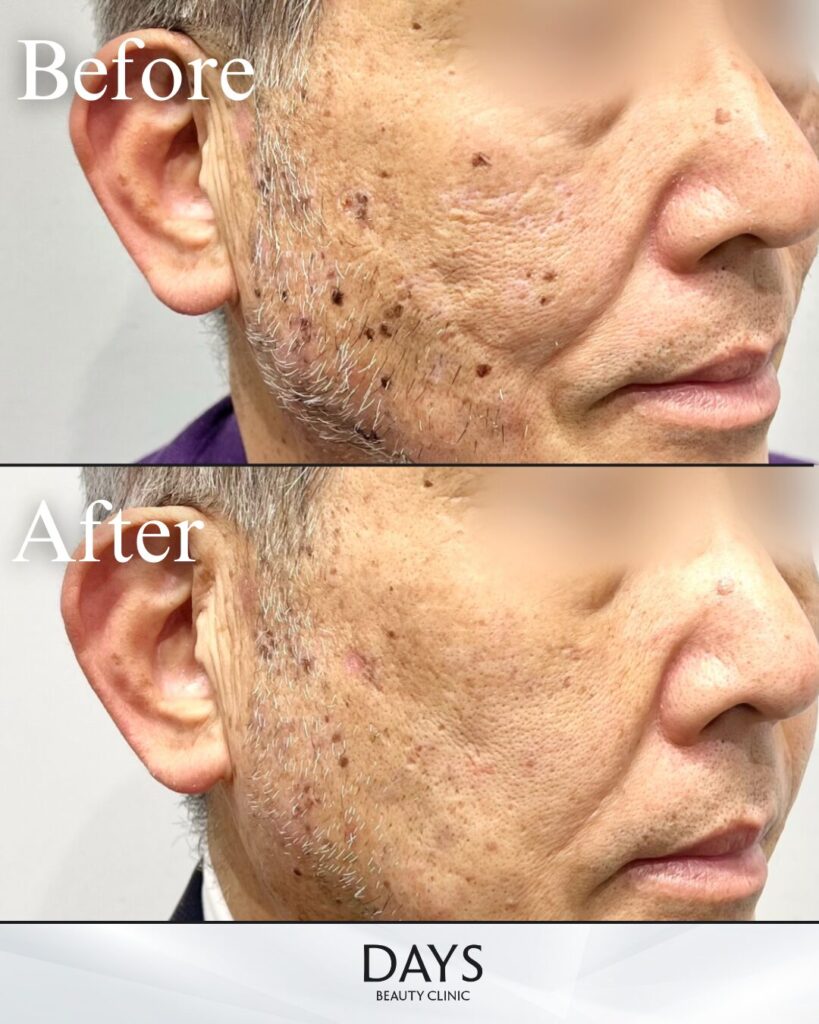 ピコスポット-の症例　70代男性