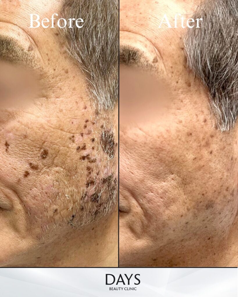 ピコスポット-の症例　70代男性