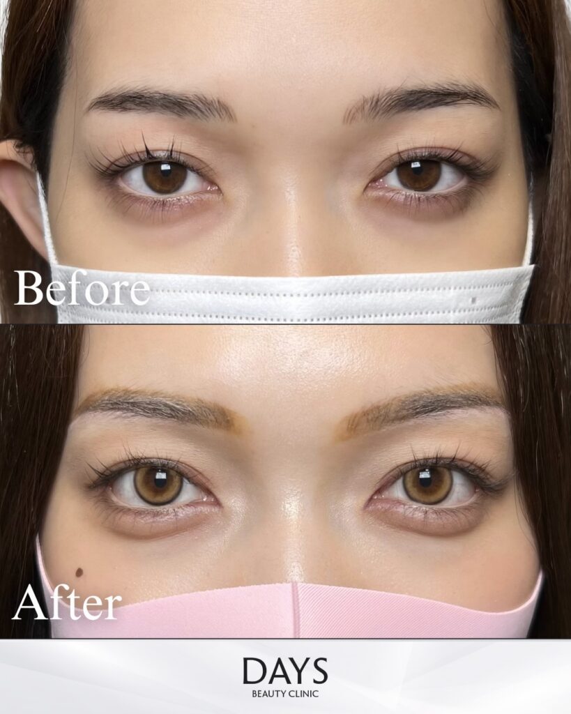 タレ目形成　症例　20代女性