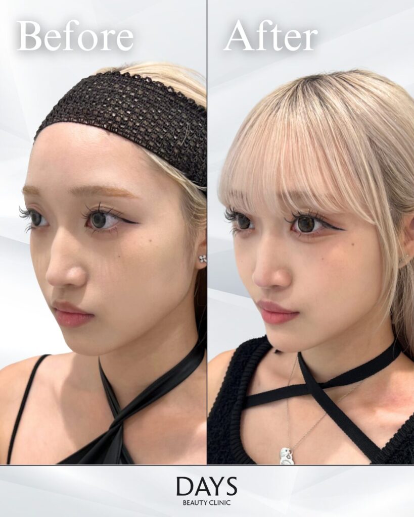 顎ヒアルロン酸　症例　20代女性