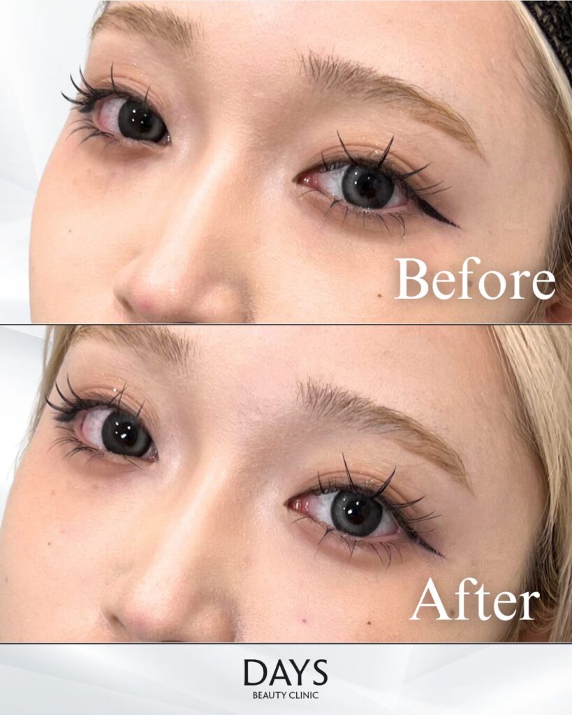 涙袋ヒアルロン酸　症例　20代女性