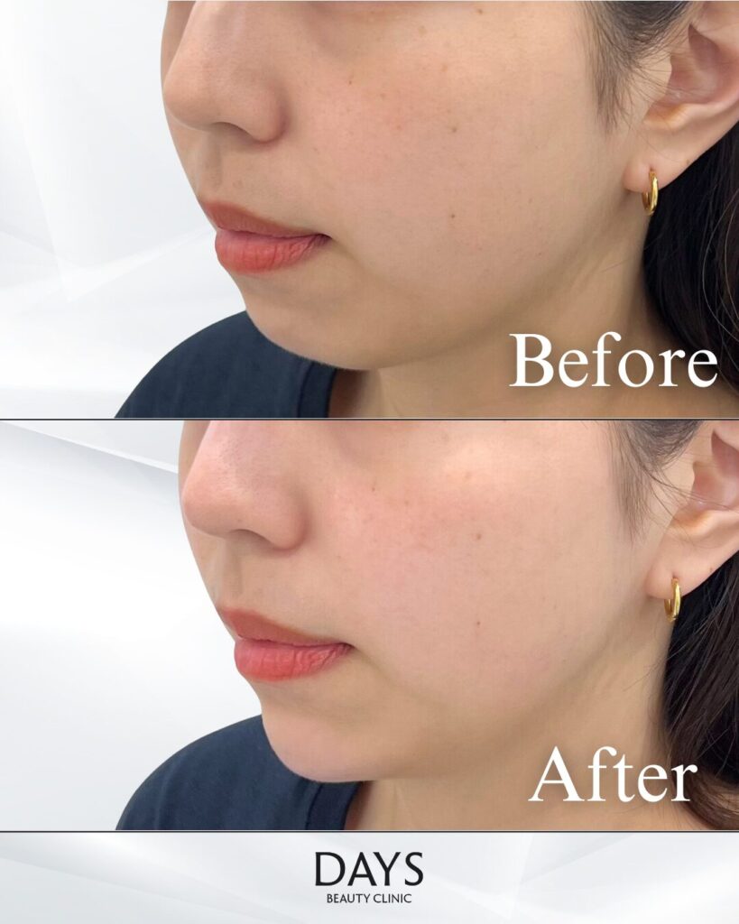 顎ヒアルロン酸　症例　20代女性