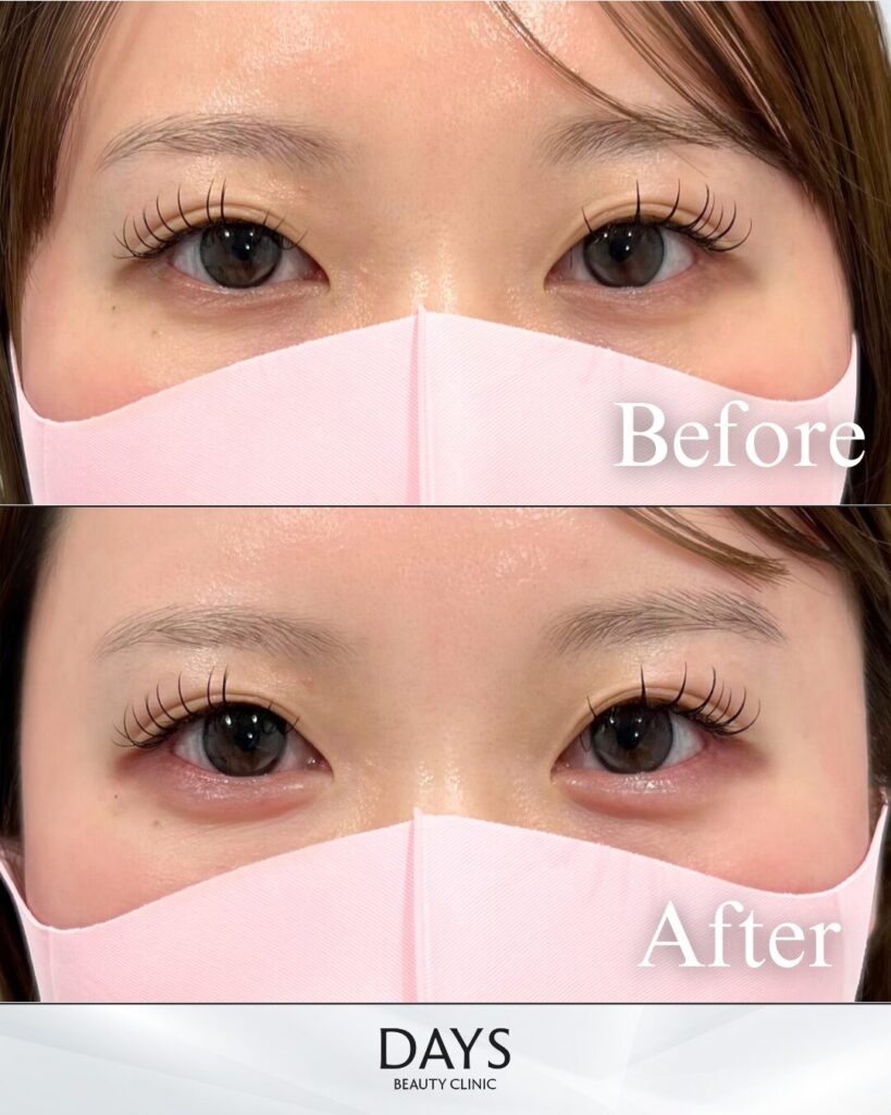 涙袋ヒアルロン酸　症例　20代女性