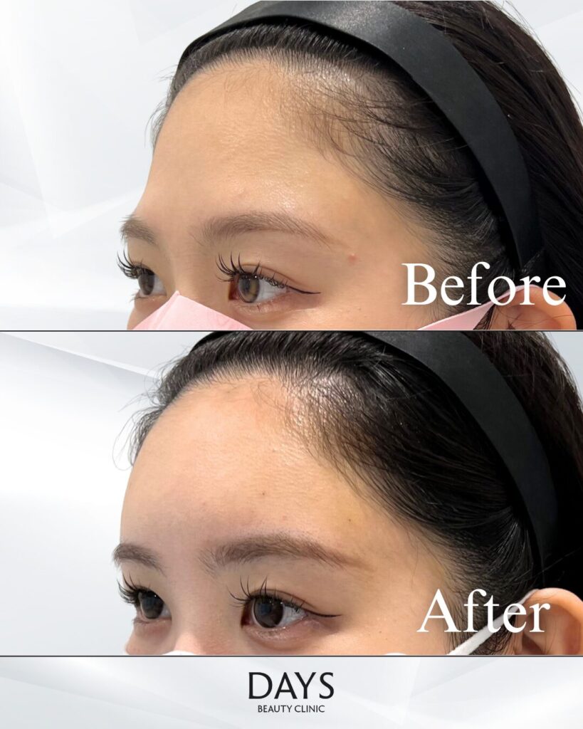 額ヒアルロン酸　症例　20代女性