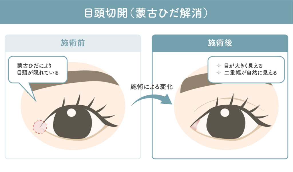 目頭切開(蒙古ひだ解消)
