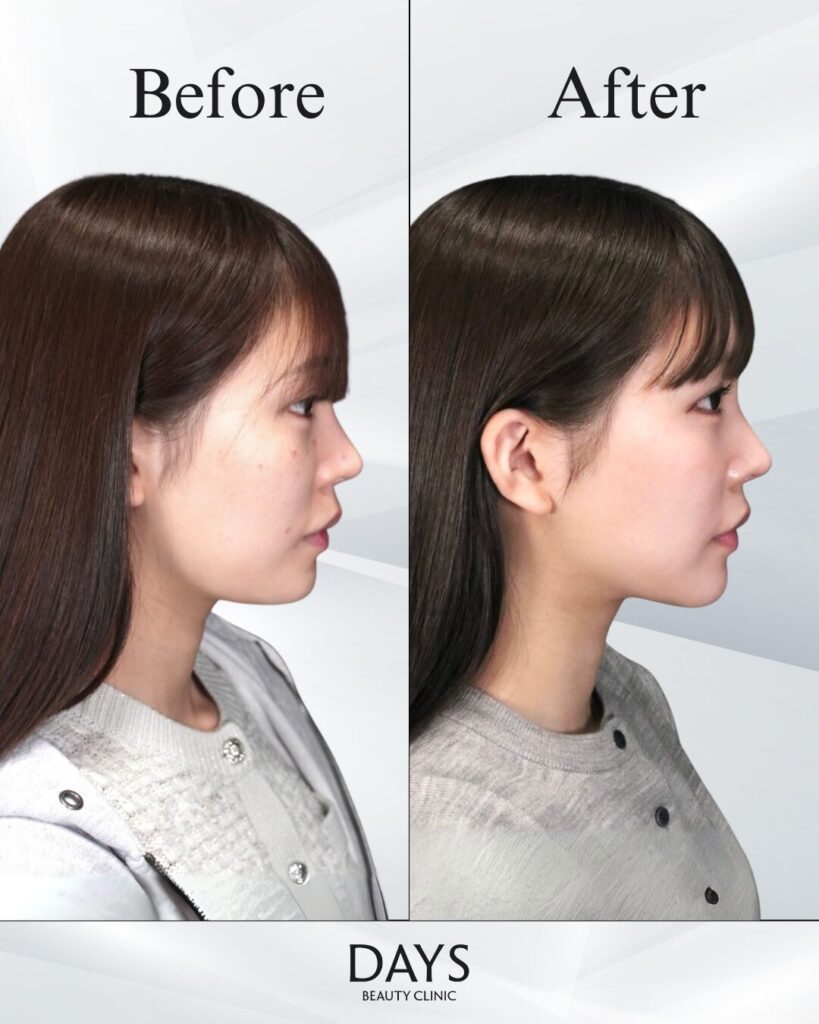 小顔　症例　20代女性