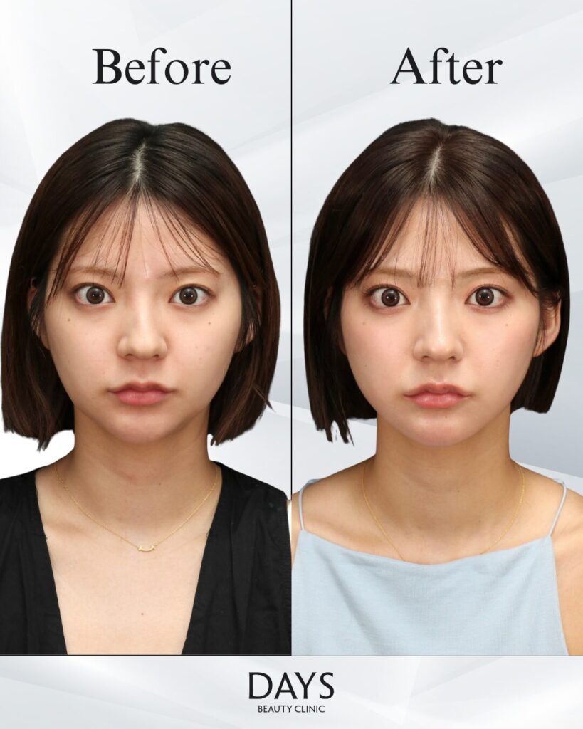 小顔　症例　20代女性