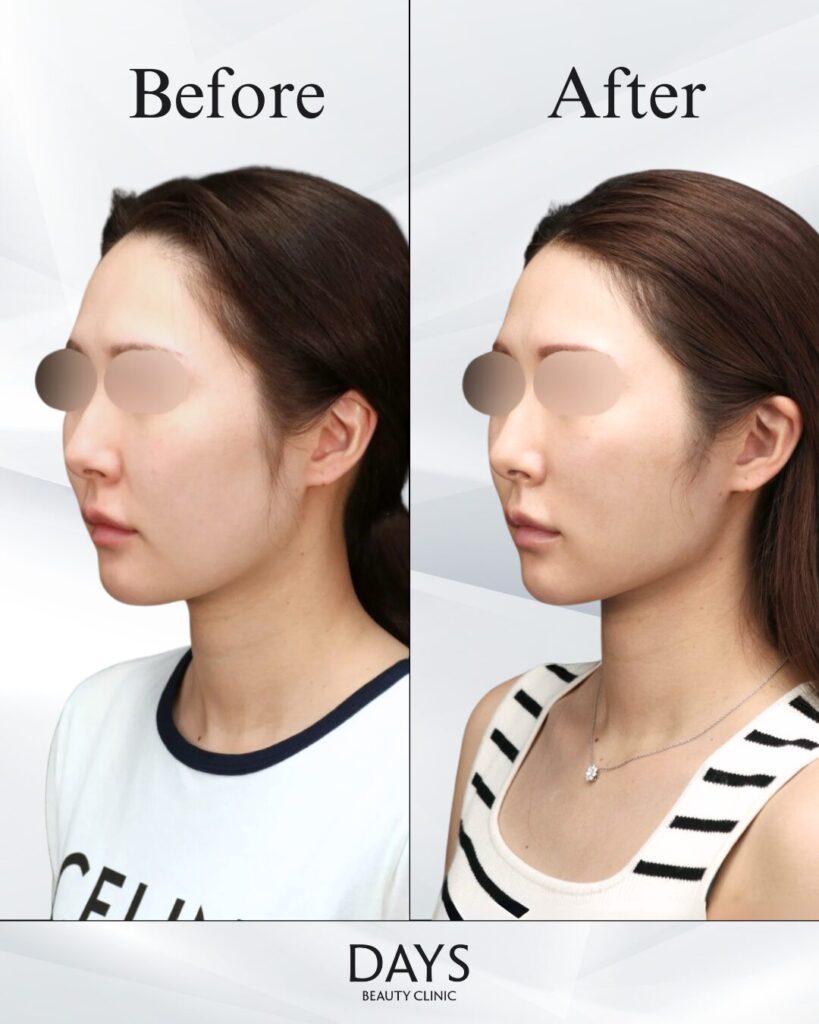 小顔　症例　30代　女性