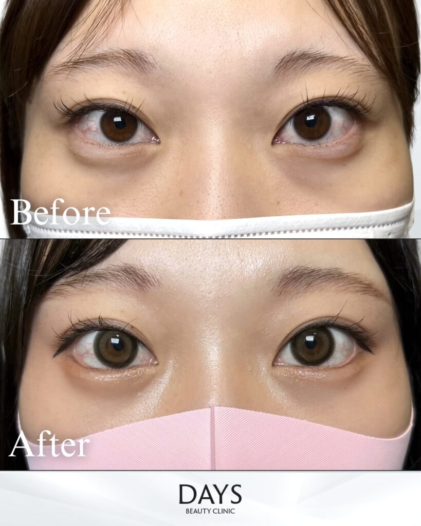 タレ目形成　症例　20代女性