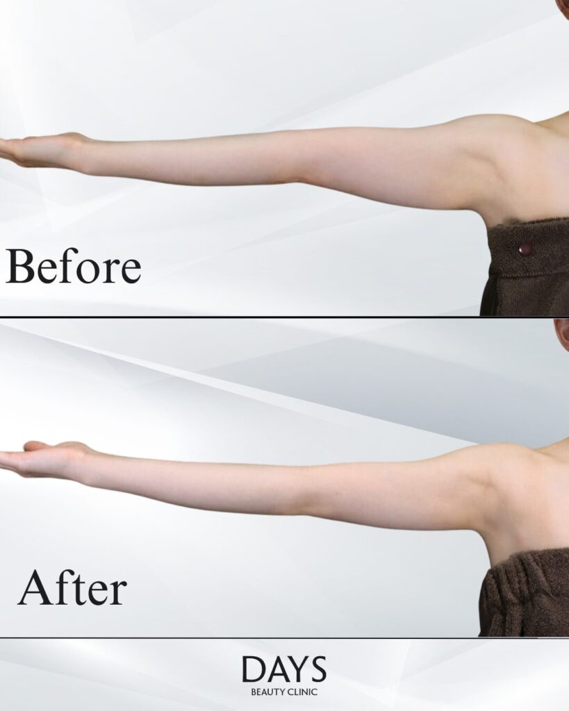 二の腕脂肪吸引　症例　20代女性