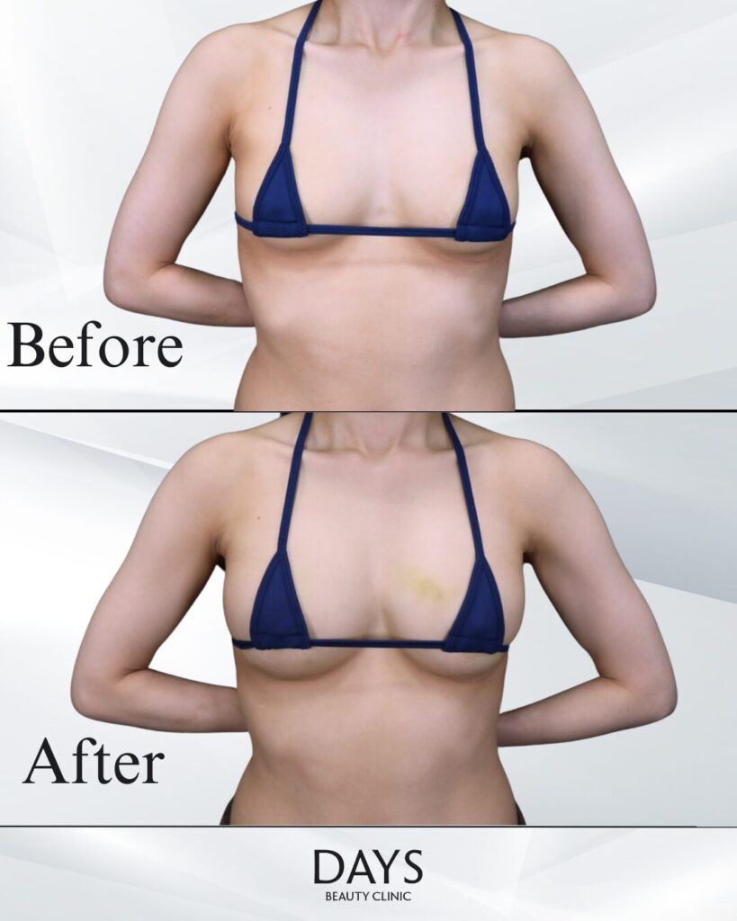 脂肪豊胸　症例　20代女性