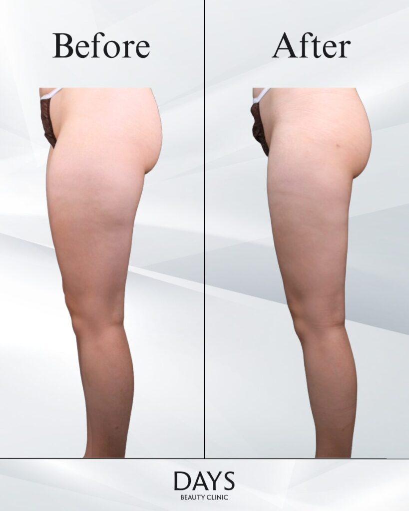 太もも脂肪吸引　症例　20代女性