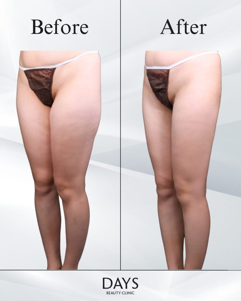 太もも脂肪吸引　症例　20代女性