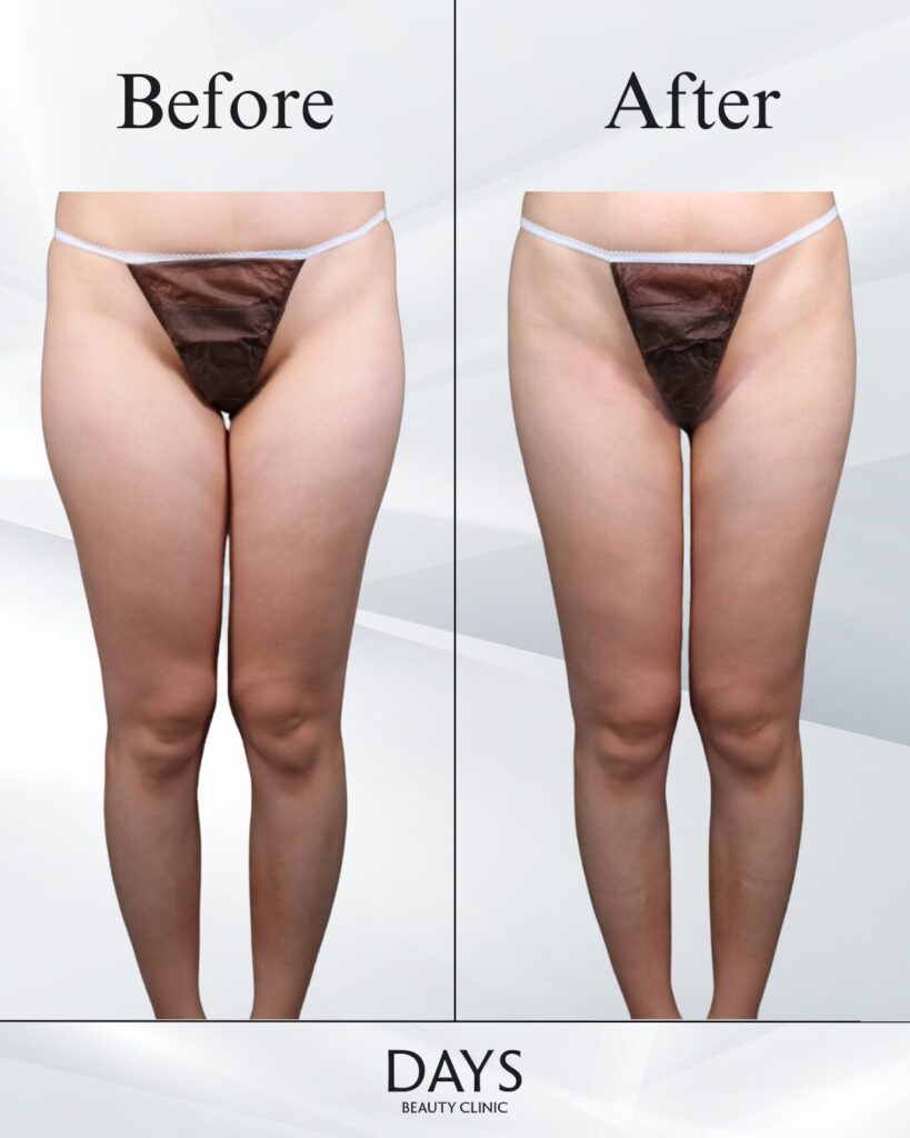 太もも脂肪吸引　症例　20代女性