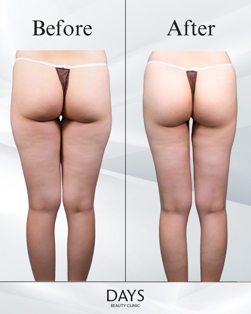 太もも脂肪吸引　症例　20代女性