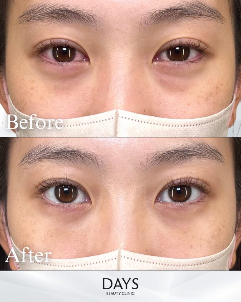 クマ取り　症例　20代　女性