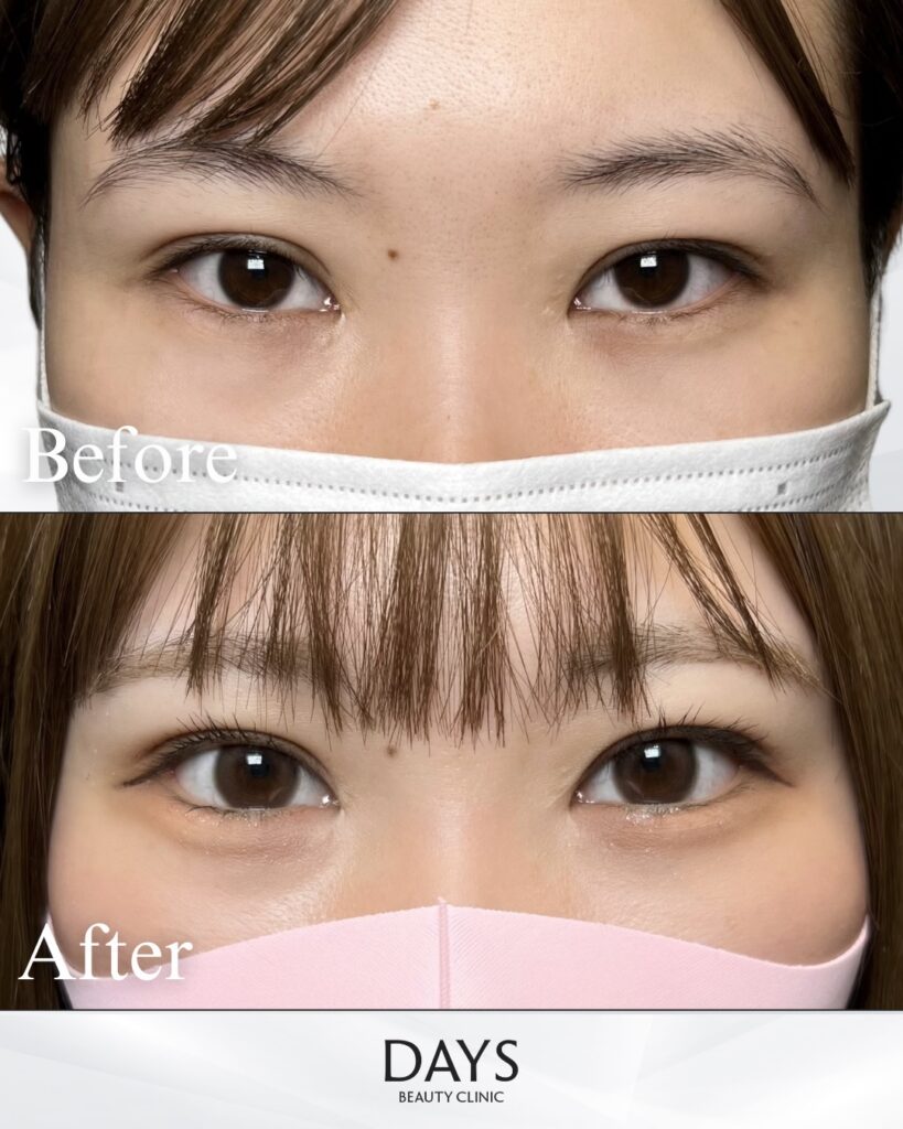 タレ目形成　症例　２０代女性