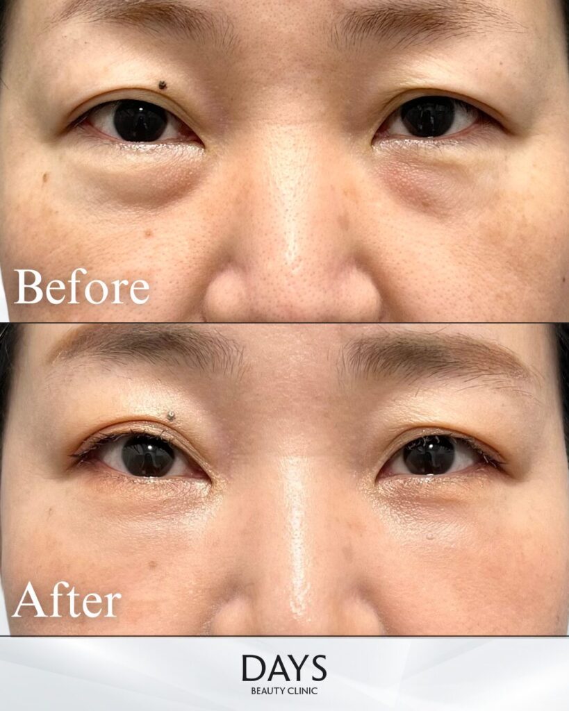 クマ取り　症例　30代　女性