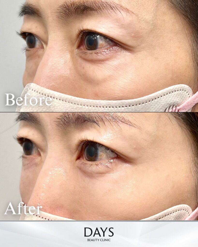 クマ取り　症例　30代　女性