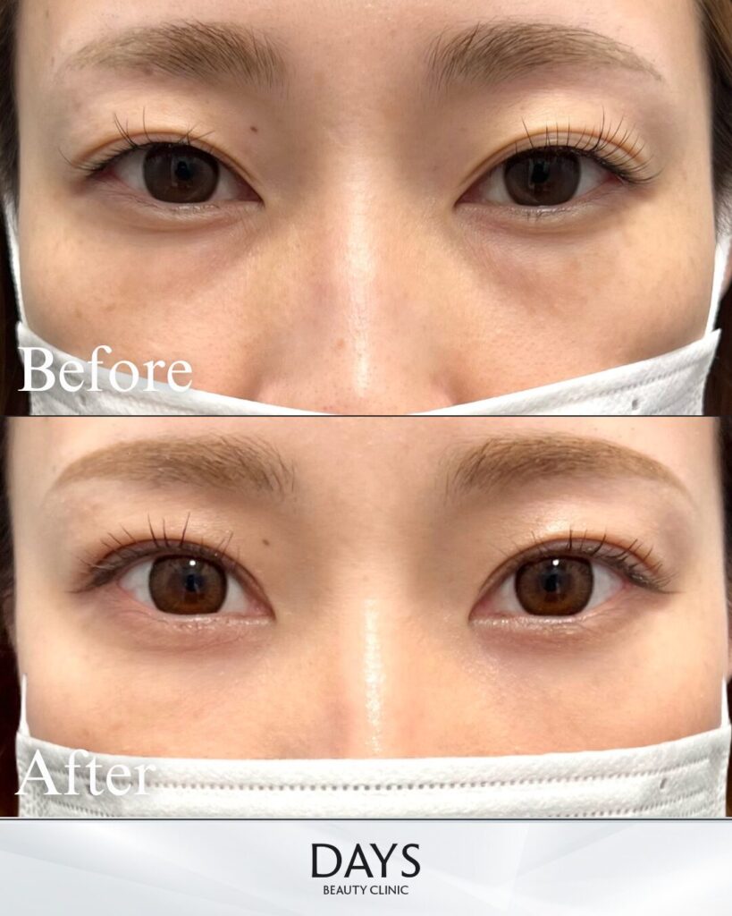 クマ取り　症例　20代　女性