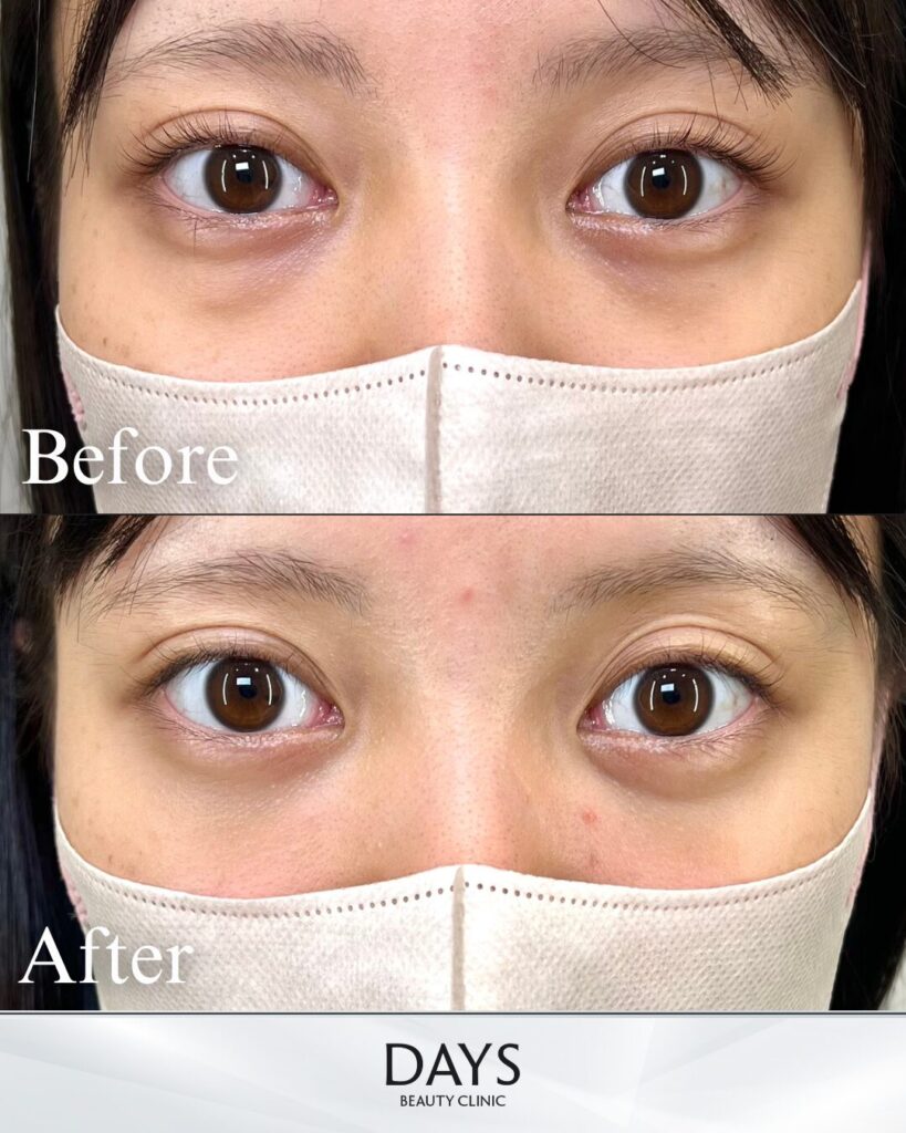 裏ハムラ　症例　20代女性