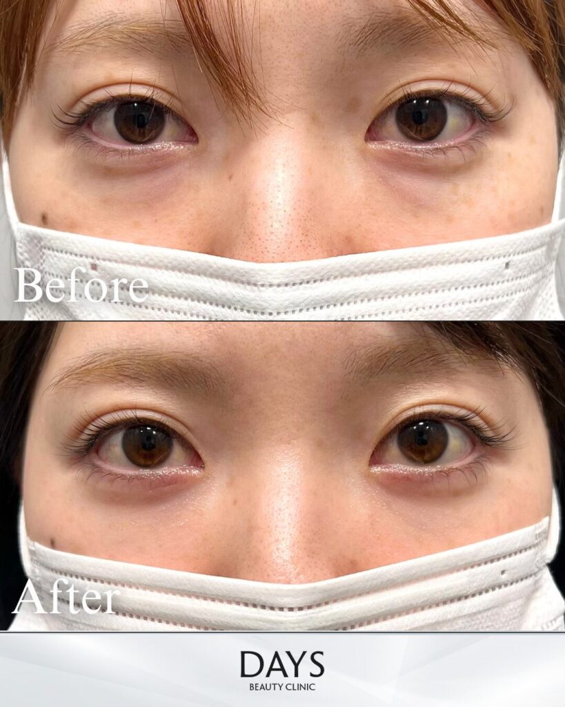 裏ハムラ　症例　30代女性