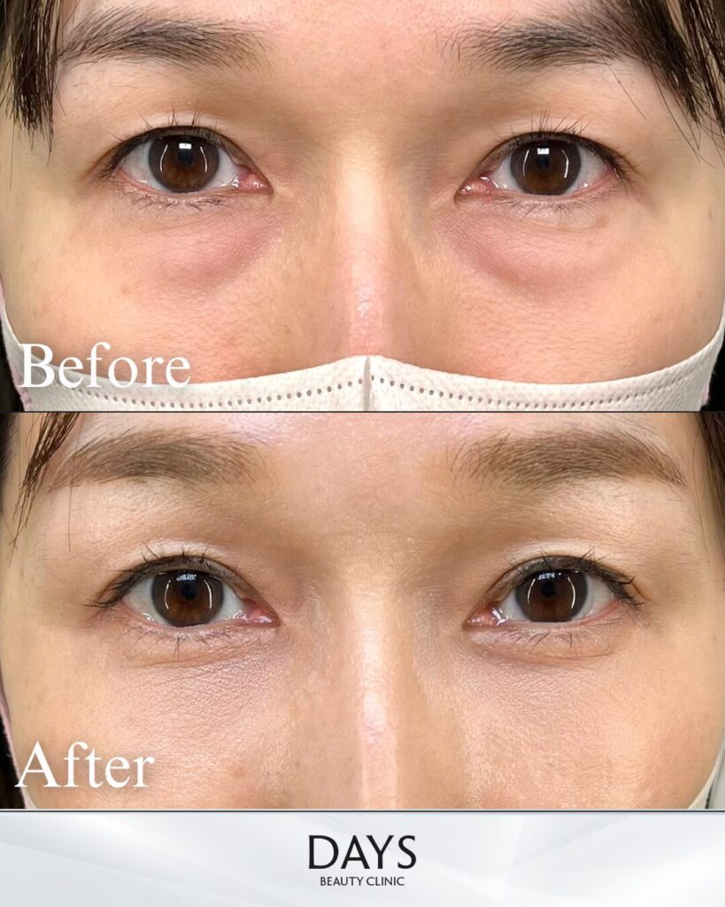 クマ取り　症例　40代　女性