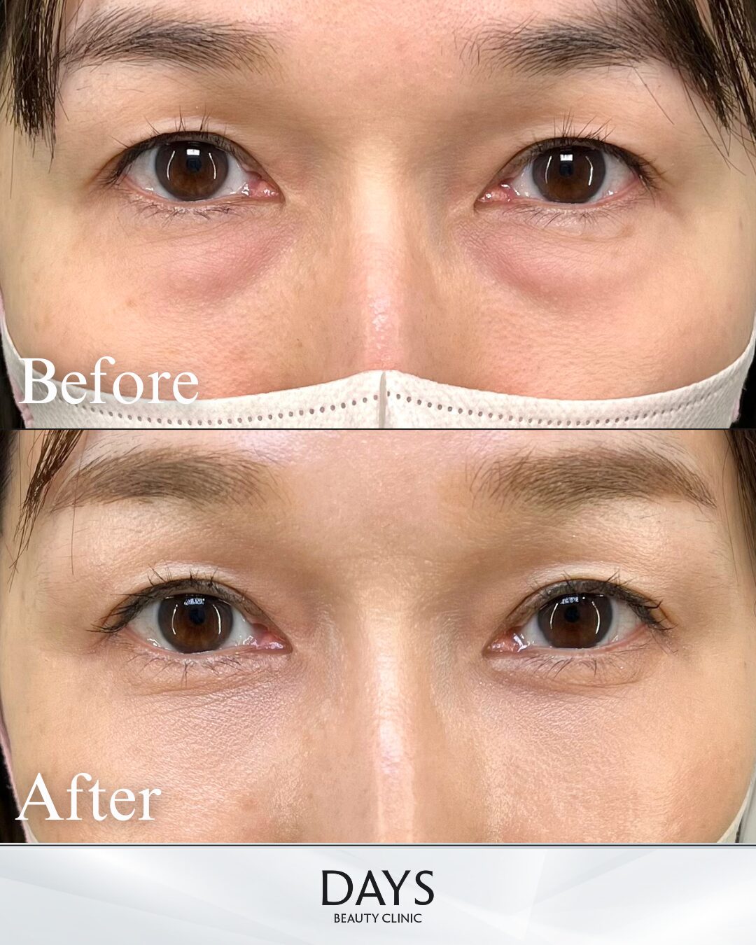 クマ取り 症例 40代 女性