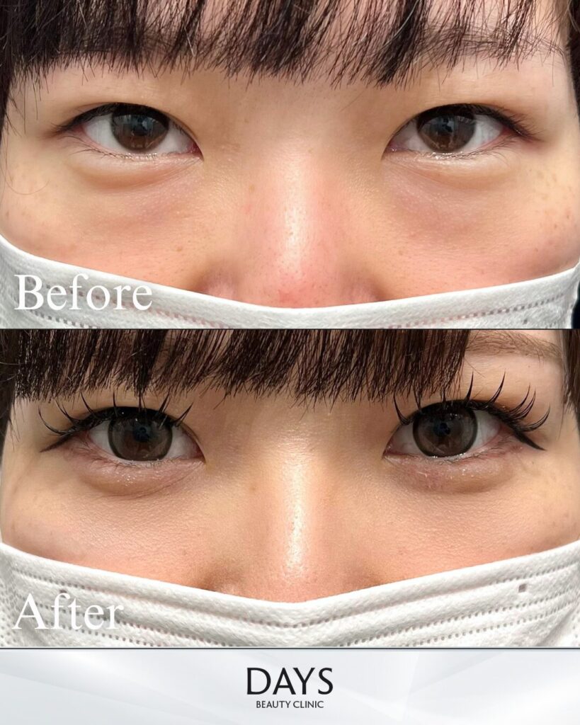 クマ取り　症例　40代　女性