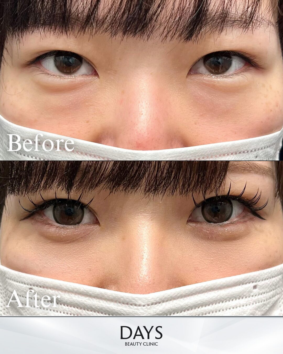 クマ取り 症例 40代 女性