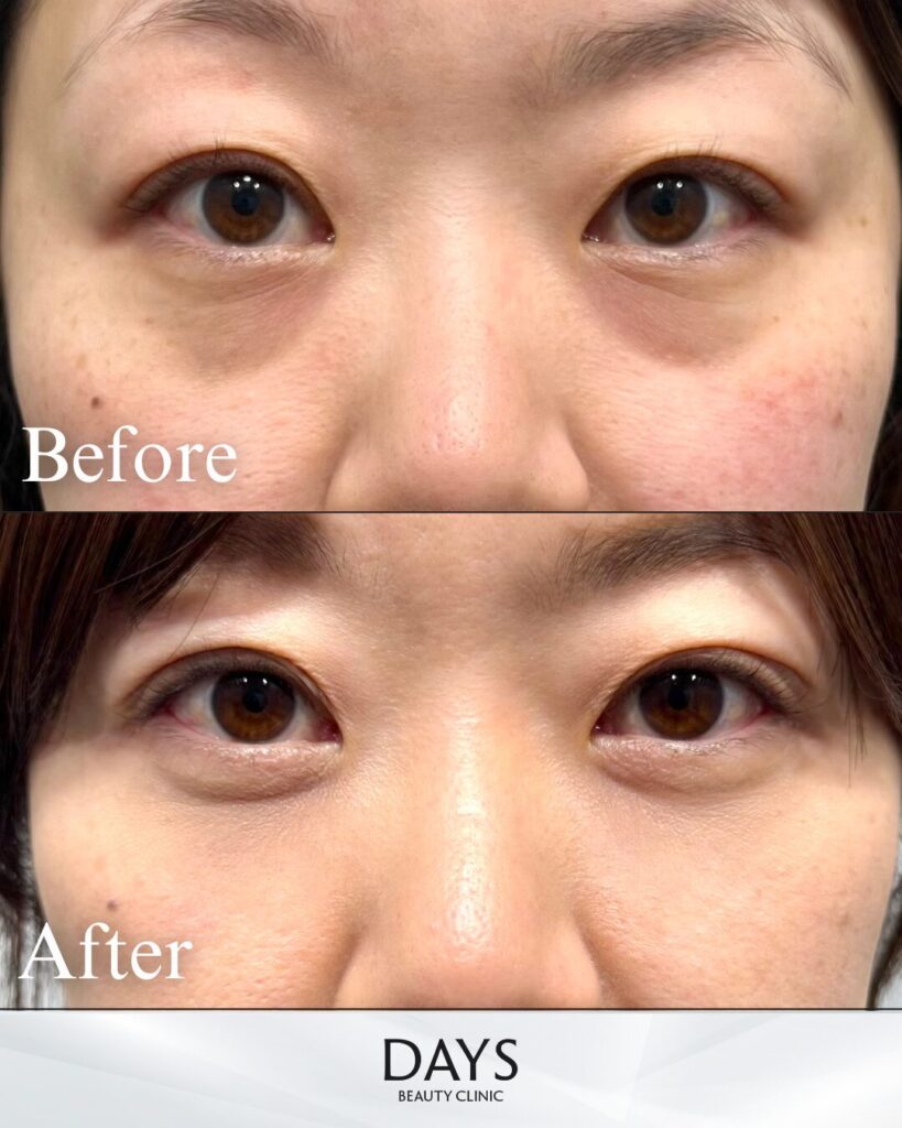 裏ハムラ　症例　50代女性