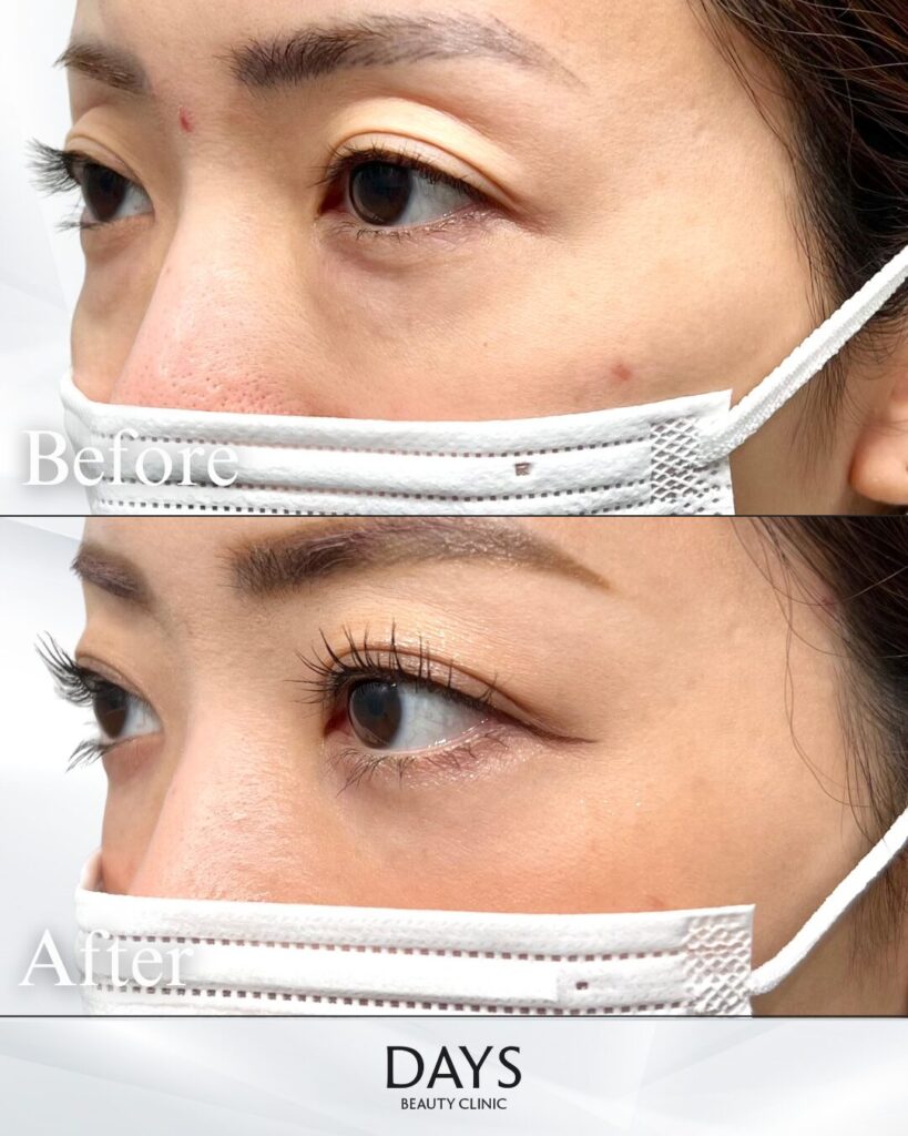 クマ取り　症例　30代　女性