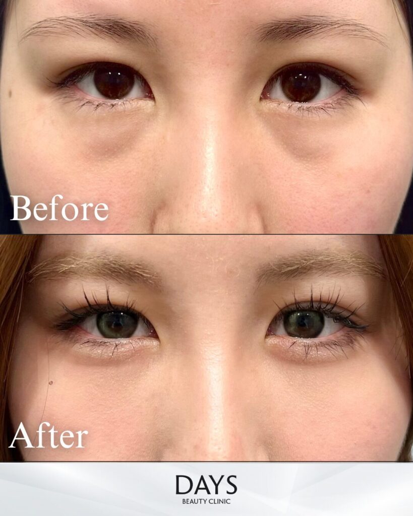 裏ハムラ　症例　20代女性