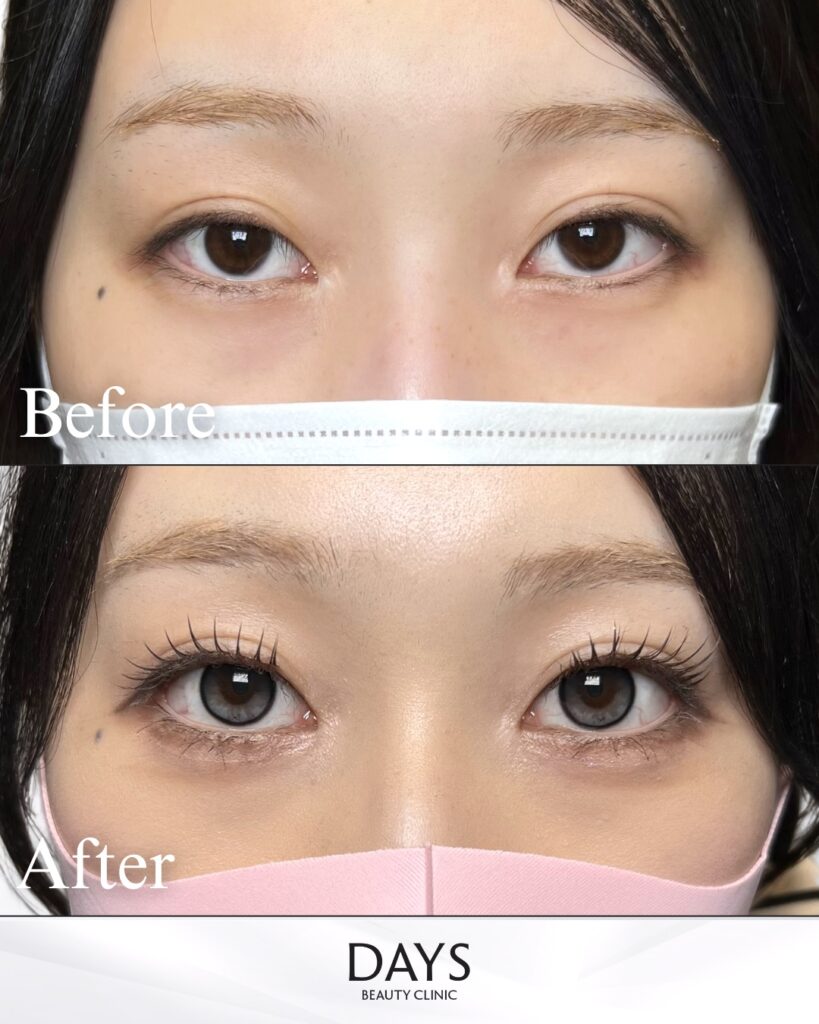 タレ目形成　症例　２０代女性