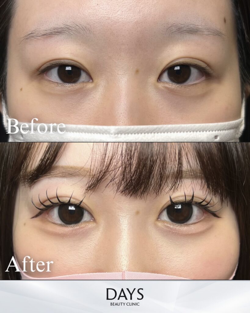 グラ　目尻　二重　症例　20代女性