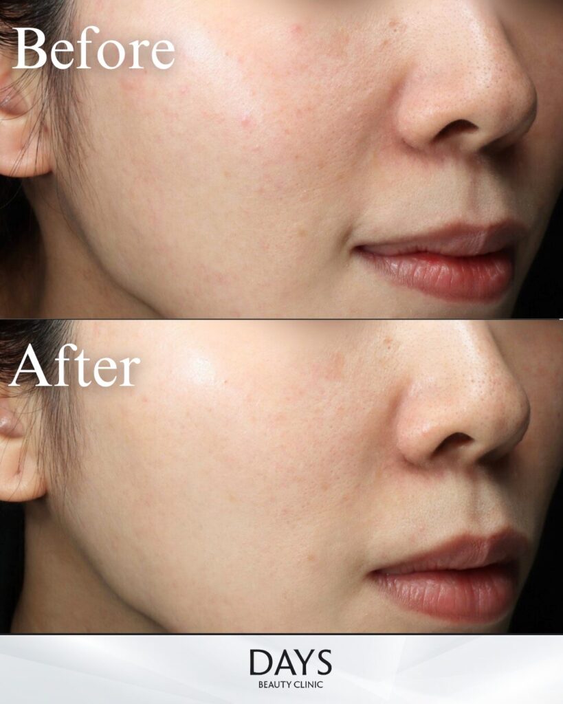 ネオファウンド　症例　20代女性