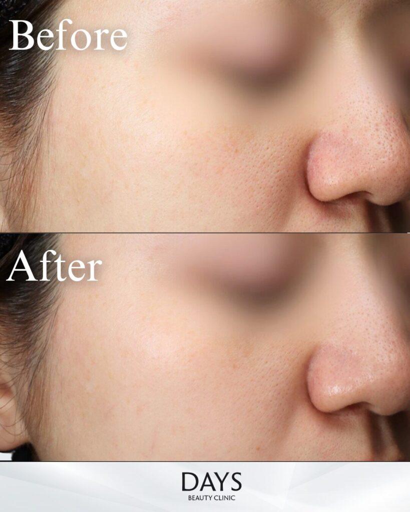 ブレッシング　症例　20代女性