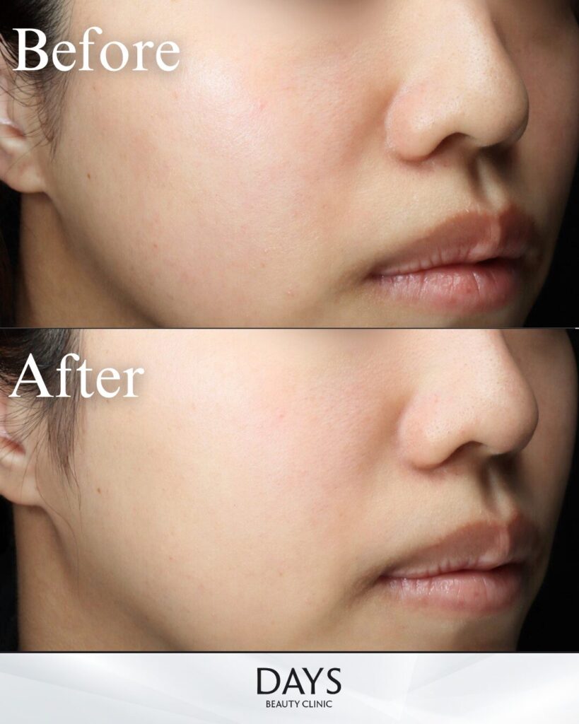 プルリアルデンシファイ　症例　20代女性