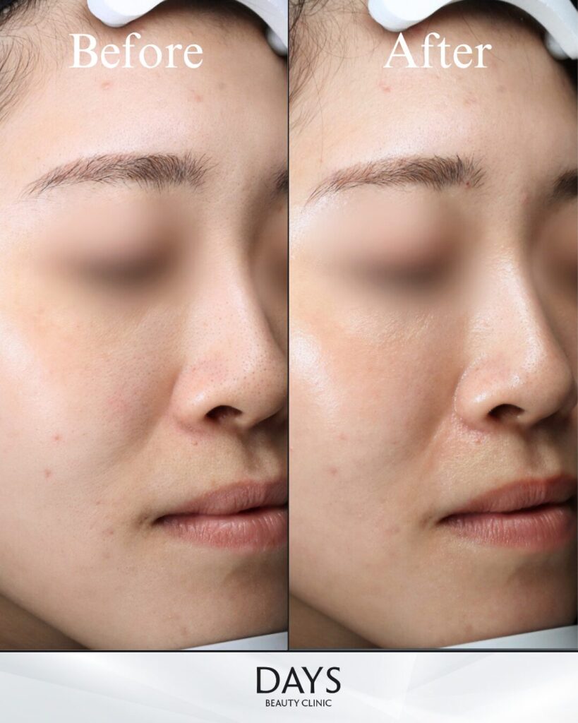 ブレッシング　症例　20代女性