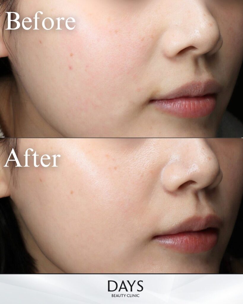 ジュベルック　症例　20代女性