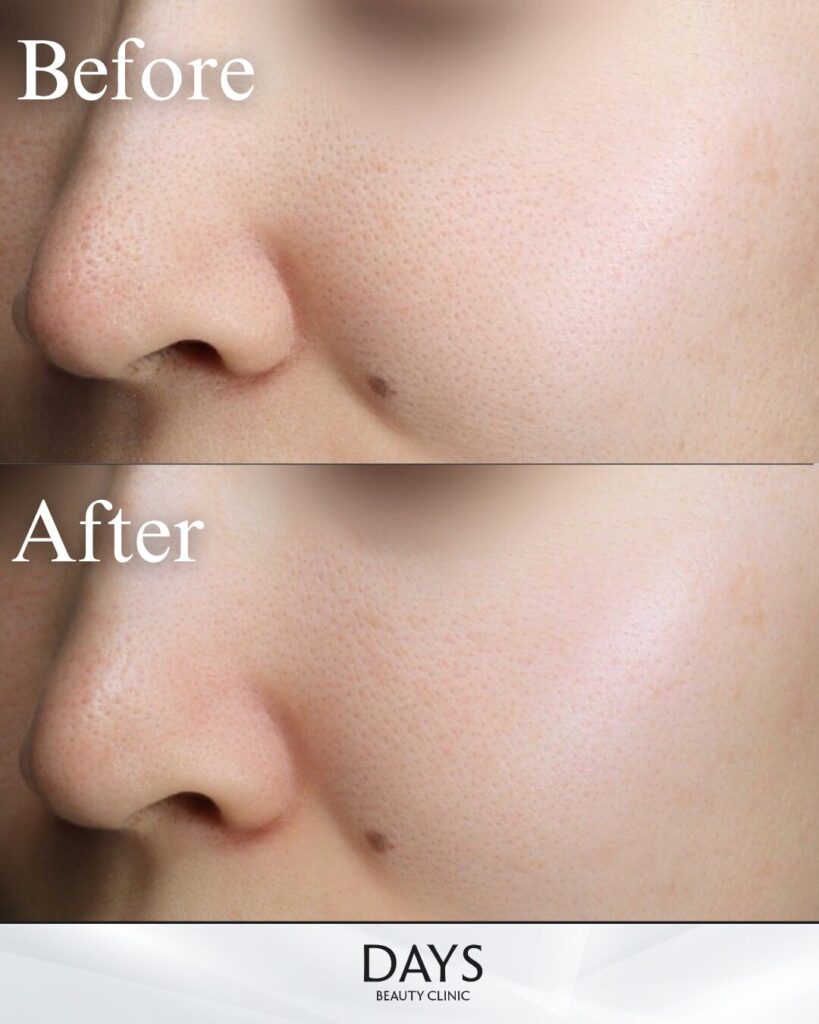 ブレッシング　症例　20代女性